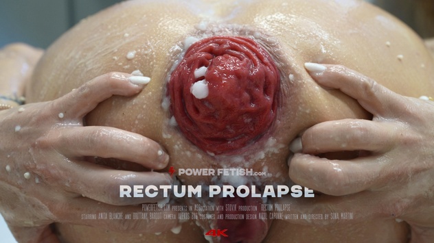 Rectum Prolapse